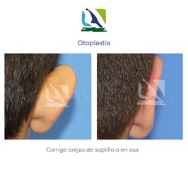 Otoplastia - Centro Clínico Quirúrgico Aranjuez