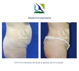 Abdominoplastia - Centro Clínico Quirúrgico Aranjuez