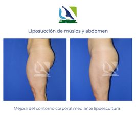 Liposucción de muslos y abdomen - Centro Clínico Quirúrgico Aranjuez