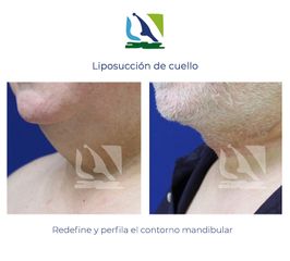Liposucción de cuello - Centro Clínico Quirúrgico Aranjuez