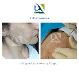 Hilos tensores - Centro Clínico Quirúrgico Aranjuez