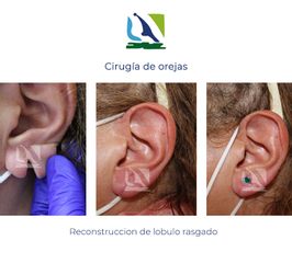 Reconstrucción de lóbulo rasgado - Centro Clínico Quirúrgico Aranjuez