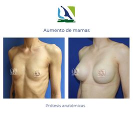 Aumento de mamas con implantes anatómicos