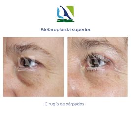 Blefaroplastia - Centro Clínico Quirúrgico Aranjuez