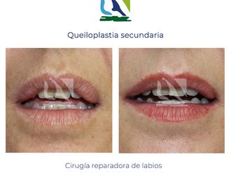 Queiloplastia - 810161
