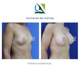 Aumento de mamas con implantes anatómicos - Centro Clínico Quirúrgico Aranjuez