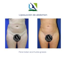 Liposucción de abdomen - Centro Clínico Quirúrgico Aranjuez