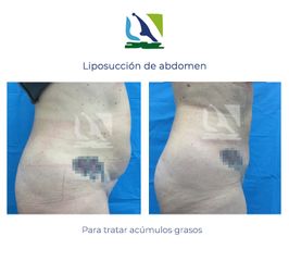 Liposucción de abdomen - Centro Clínico Quirúrgico Aranjuez