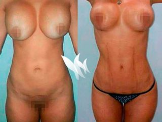 Antes y después Recambio de prótesis y Marcaje abdominal