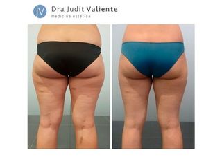 Antes y después Criolipólisis