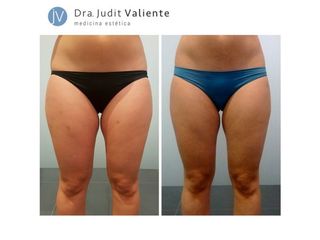 Antes y después Criolipólisis
