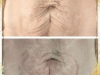 Celulitis antes y después - 858435