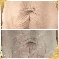 Celulitis - Glow Biosthetic