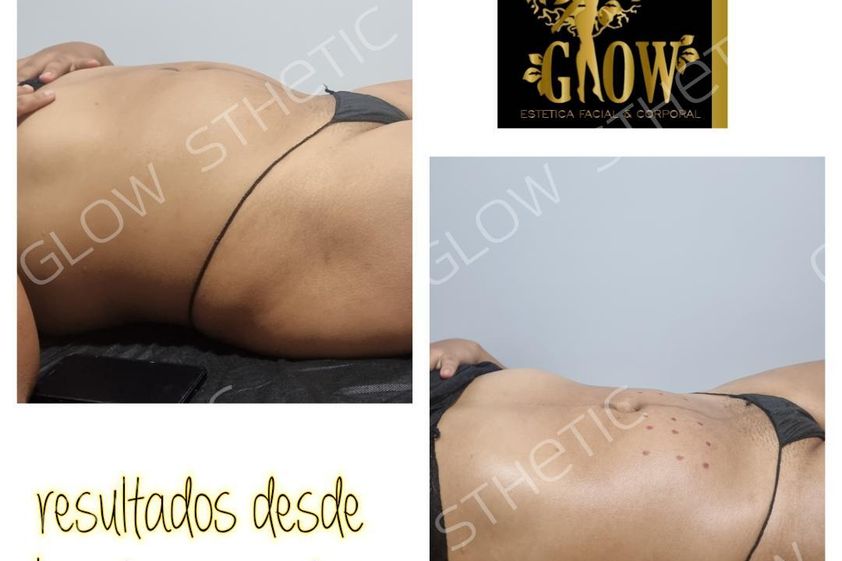 Mesoterapia antes y después - 858436