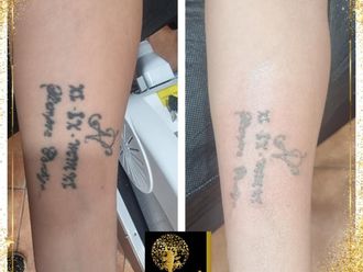 Eliminación de tatuajes - 858439