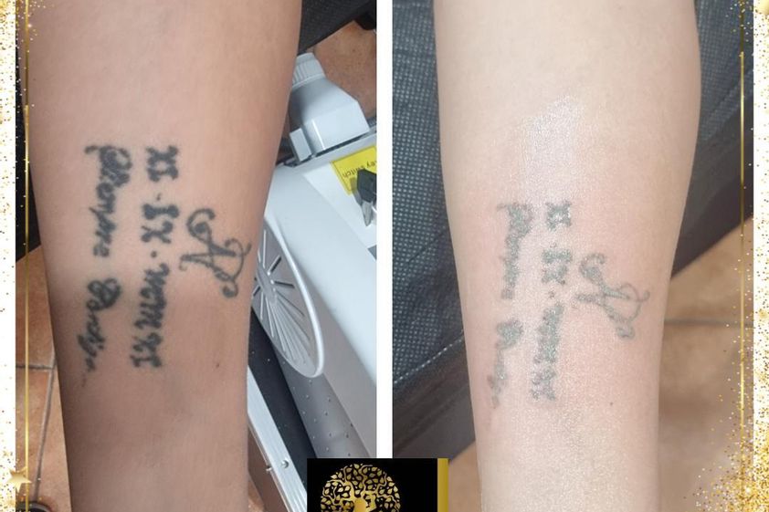 Eliminación de tatuajes antes y después - 858439