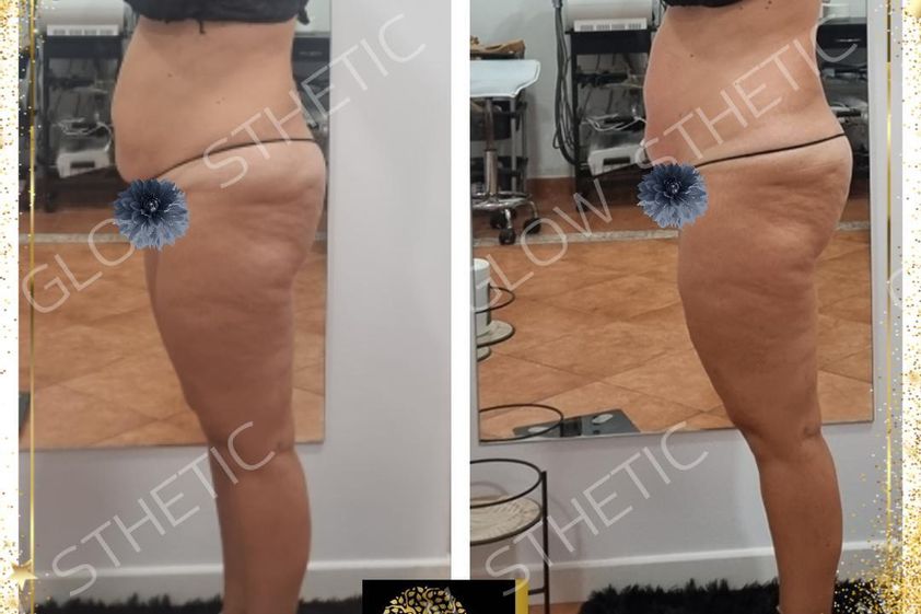 Celulitis antes y después - 858441