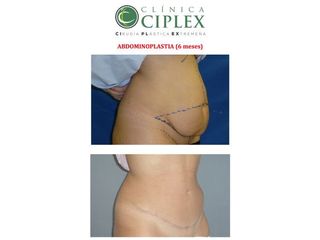 Abdominoplastia
