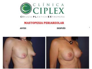 Mastopexia Periareolar