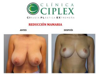 Reducción Mamaria