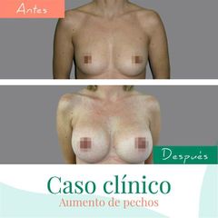 Aumento de pecho - Clínica CIPLEX