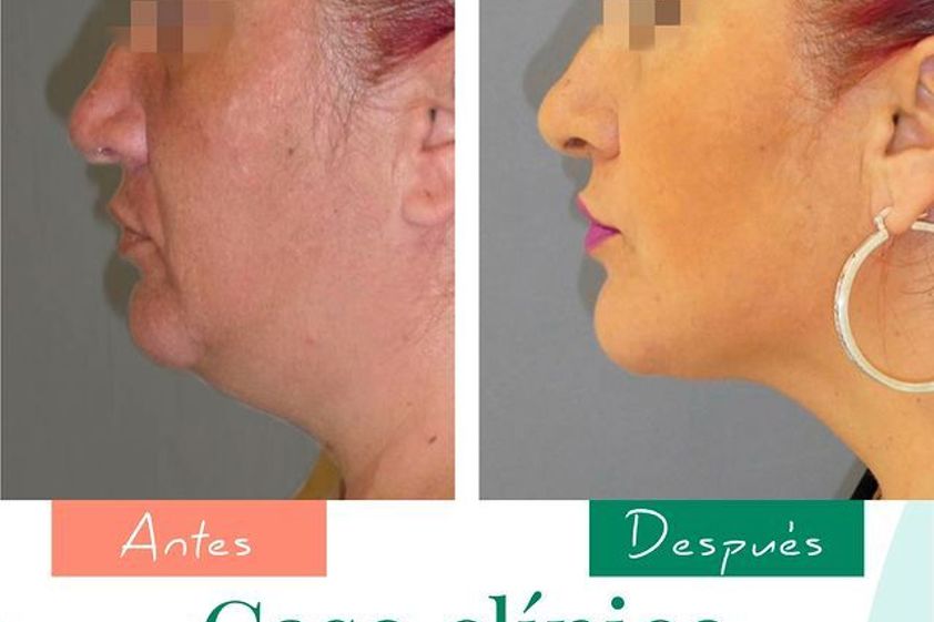 Liposucción de papada antes y después - 796738