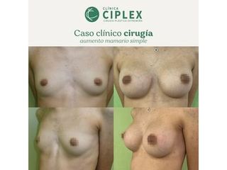 Aumento mamario - Clínica CIPLEX