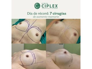 Aumento mamario - Clínica CIPLEX
