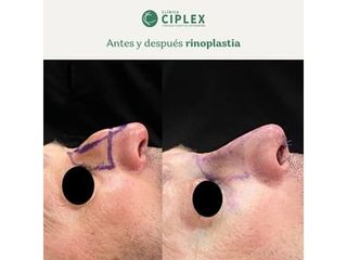Rinoplastia - Clínica CIPLEX