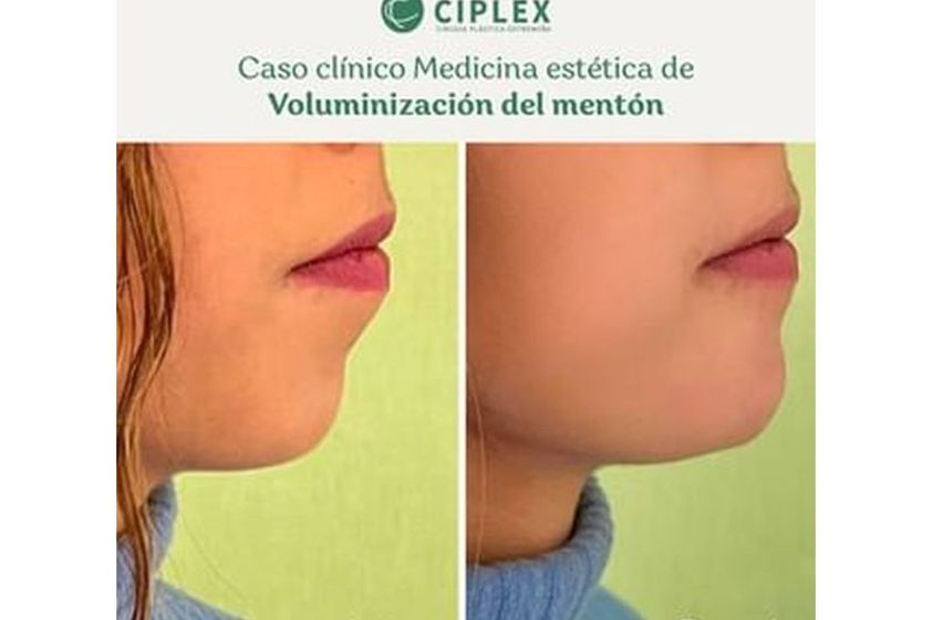 Aumento mentón antes y después - 816687