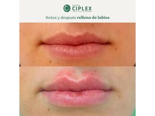 Relleno de labios - Clínica CIPLEX