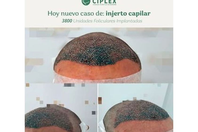 Tratamiento capilar antes y después - 816689