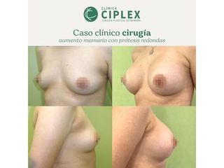Aumento mamario - Clínica CIPLEX