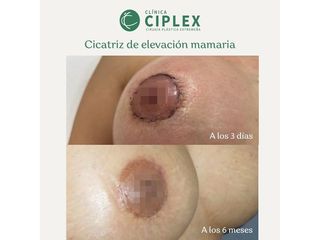 Mastopexia - Clínica CIPLEX