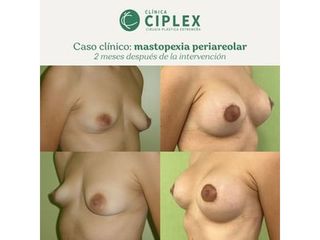 Mastopexia - Clínica CIPLEX