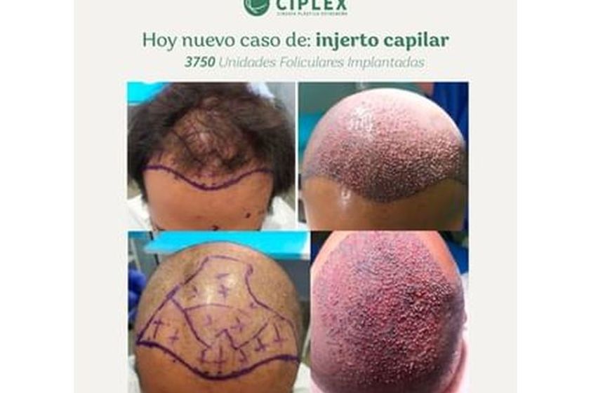 Tratamiento capilar antes y después - 816695