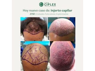 Injerto capilar - Clínica CIPLEX