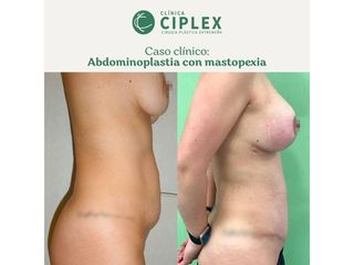 Abdominoplastia - Clínica CIPLEX