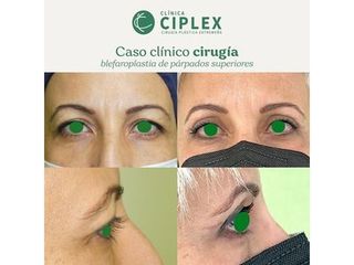 Blefaroplastia - Clínica CIPLEX