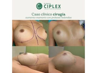 Aumento mamario - Clínica CIPLEX
