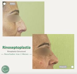 Rinoplastia - Clínica CIPLEX