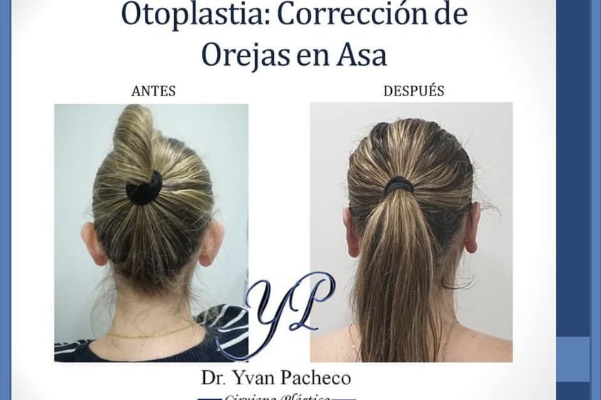 Otoplastia antes y después - 865275