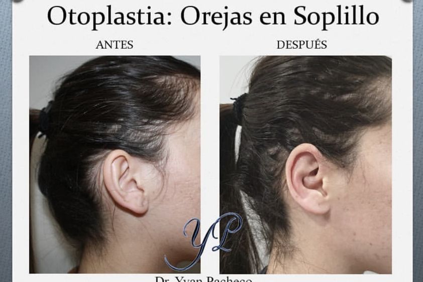 Otoplastia antes y después - 865276