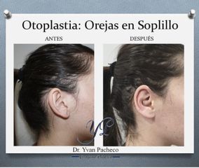 Otoplastia - Dr. Yvan Pacheco