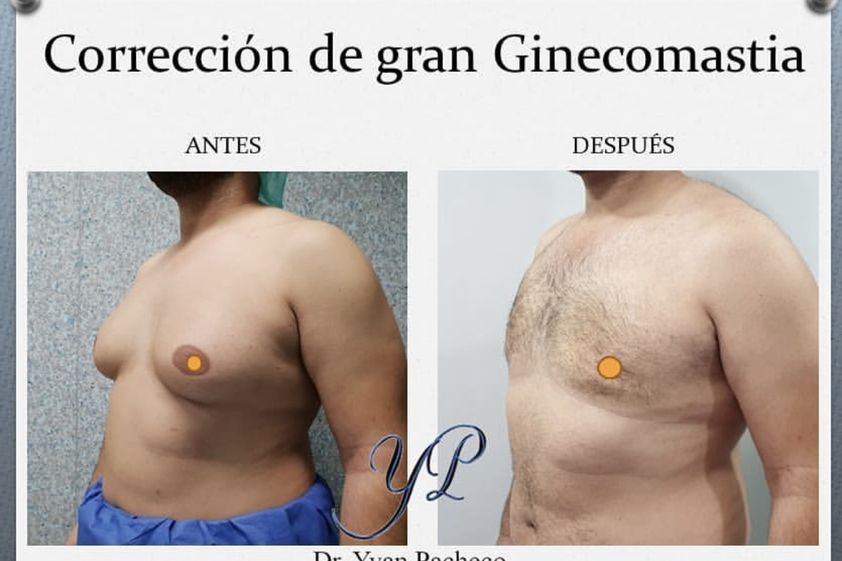 Ginecomastia antes y después - 865277