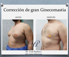 Ginecomastia - Dr. Yvan Pacheco