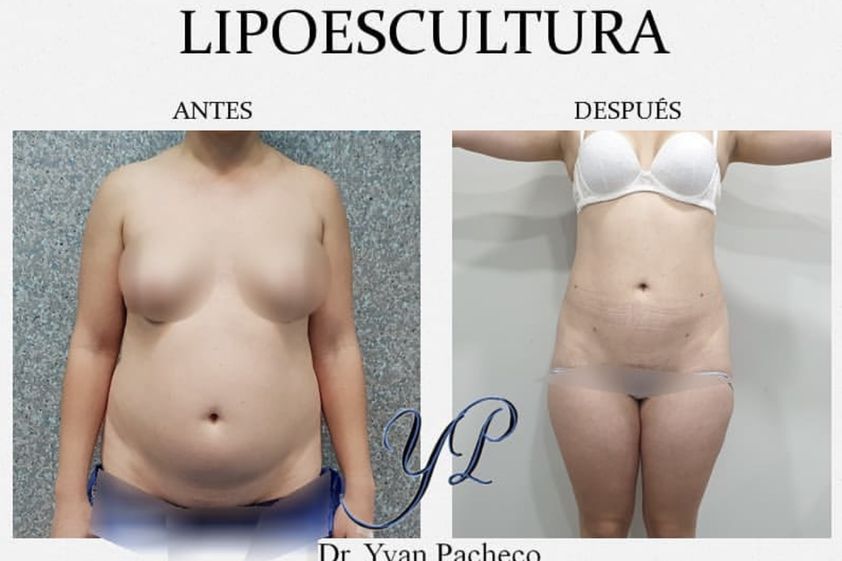 Lipoescultura antes y después - 865278