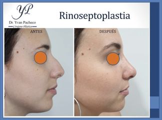Rinoplastia - Dr. Yvan Pacheco