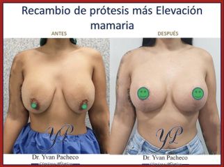 Reconstrucción mamaria - Dr. Yvan Pacheco