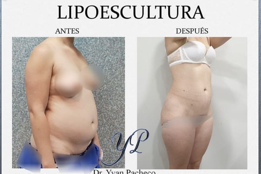 Lipoescultura antes y después - 865282